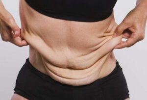 افتادگی پوست ناحیه شکم بعد از عمل جراحی چاقی
