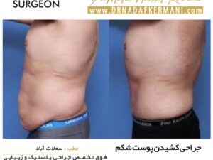 جراحی زیبایی پوست بعد از عمل جراحی چاقی