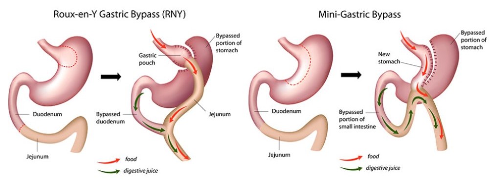 تفاوت بای پس و مینی بای پس معده