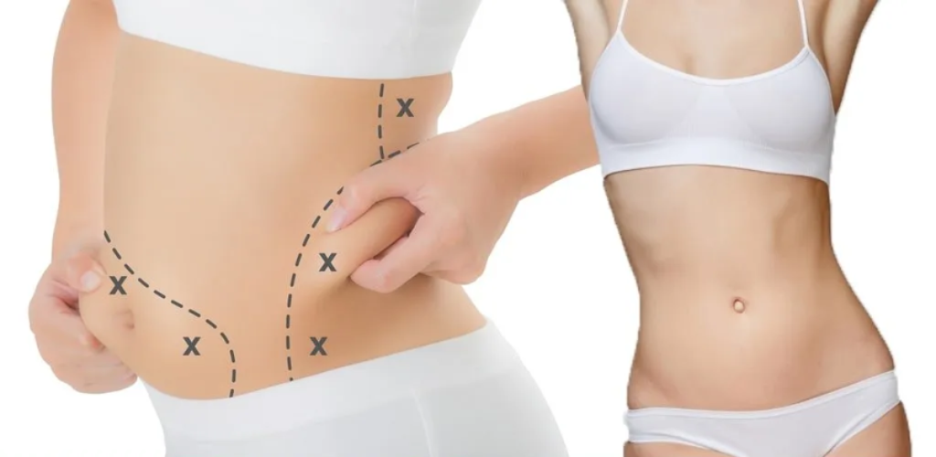 کاهش وزن سریع با جراحیهای لاغری- بهترین جراح چاقی- دکتر طالبیان