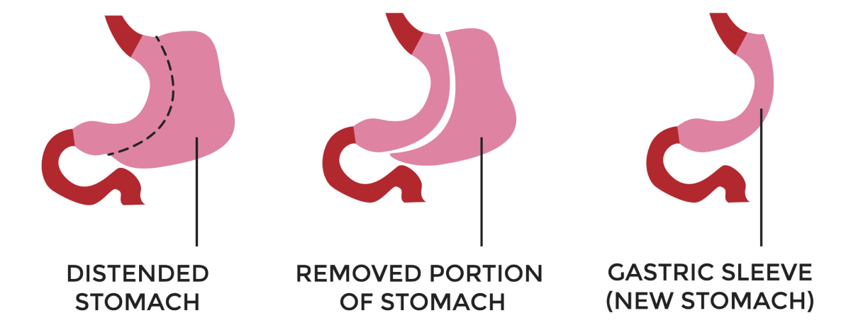 تفاوت اسلیو معده و بای‌ پس معده- بهترین جراح چاقی- دکتر طالبیان