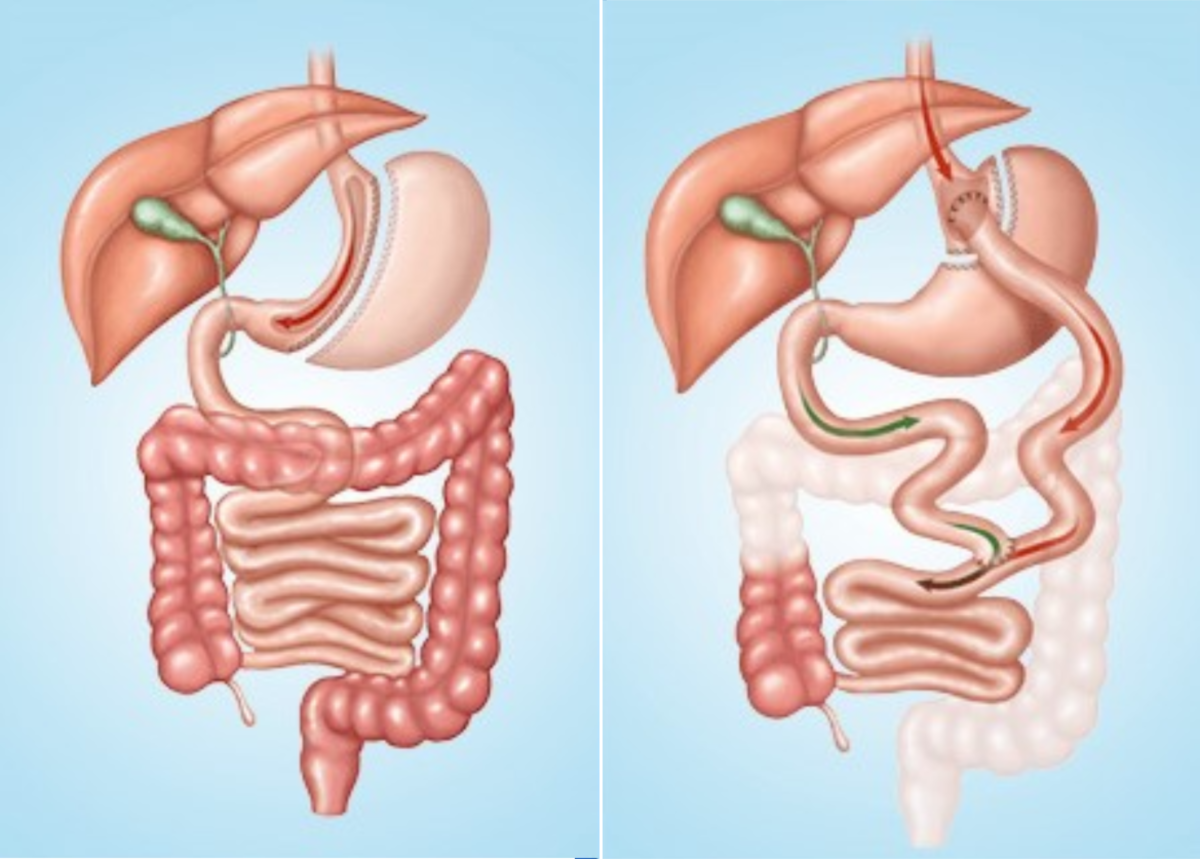 تفاوت اسلیو معده و بای‌ پس معده- بهترین جراح چاقی- دکتر طالبیان