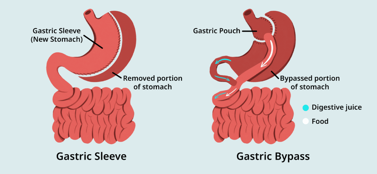 تفاوت اسلیو معده و بای‌ پس معده- بهترین جراح چاقی- دکتر طالبیان